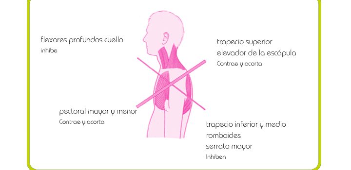 Síndrome cruzado superior: ¿Qué es y cómo tratarlo?