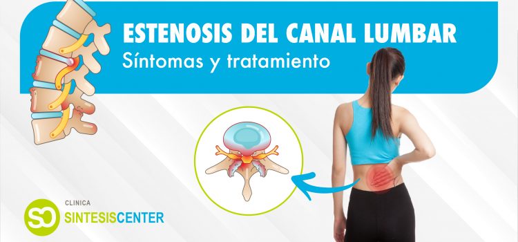 ¿Qué es la estenosis del canal lumbar? Síntomas y tratamiento