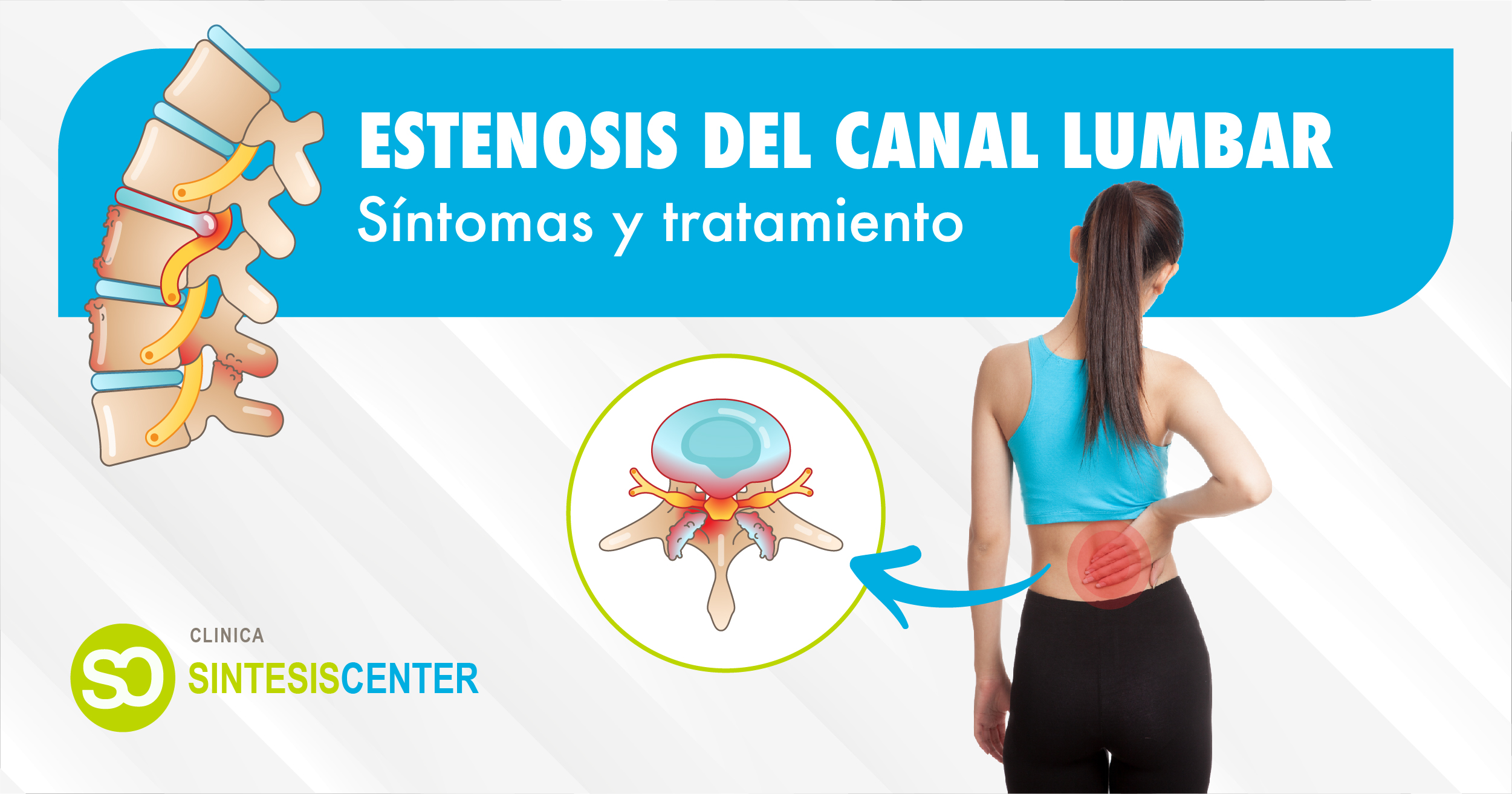 estenosis del canal lumbar